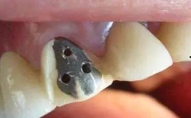 拆烤瓷牙视频,专业视角下的牙科技术解析